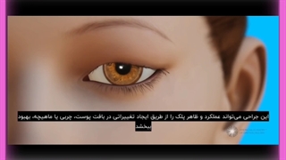 افتادگی پلک