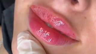 تزریق یک سی‌سی ژل لب برای مراجعه کننده عزیزمون