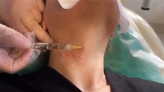 تزریق مزوژل جالپرو روش جدید جوان سازی خطوط عرضی گردن