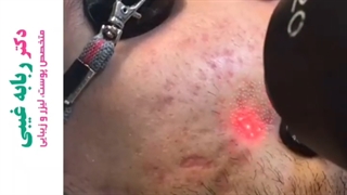 رفع جای جوش