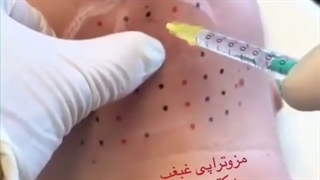 مزوتراپى لیپولیتیک براى رفع غبغب. ارتودنسی