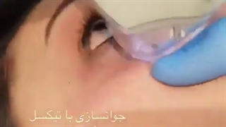 تیکسل جدیدترین روش جوانسازى پوست