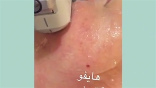 هایفوتراپى