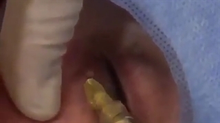 جوانسازی دور چشم با تزریق نانوفت