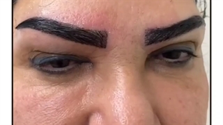 کاشت ابرو با موی سفید