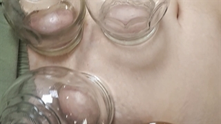 بادکش درمانی