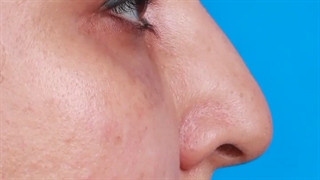 جراحی بینی استخوانی به فرم طبیعی