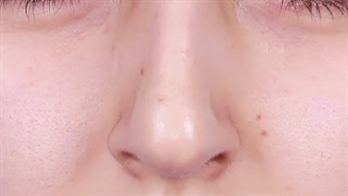 جراحی بینی استخوانی به روش مدرن