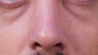 افتادگی نوک بینی