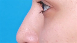 جراحی بینی استخوانی