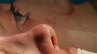 ۶ماه بعد از جراحی بینی