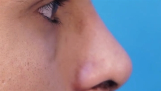 عمل بینی مردانه گوشتی