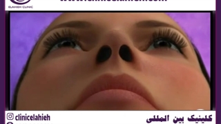 آلارپلاستی