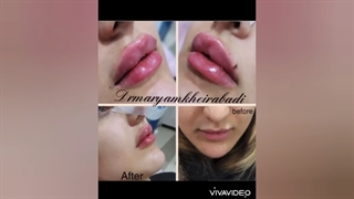 تزریق فیلر لب روسی