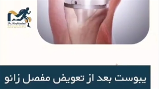 یبوست بعد از تعویض مفصل زانو✨