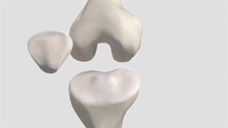 تعویض مفصل زانو چگونه انجام میشود؟