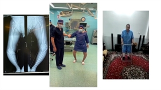 جراحی تعویض مفصل هر د وزانو در آقای ۵۹ ساله با انحراف شدید زانوها