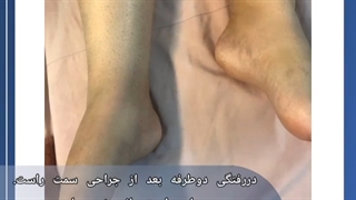 دررفتگی مادرزادی لگن