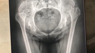 نـشانه های شکستگی لگن