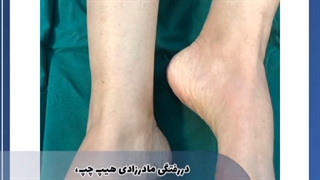 دررفتگی مادرزادی هیپ چپ و دررفتگی در پا راست