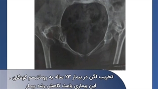 تخریب لگن در بیمار ۲۳ ساله مبتلا به روماتیسم کودکان.