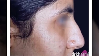 شما بینیتونو پیش متخصص گوشو حلقرو بینی جراحی کردین یا جراح پلاستیک؟