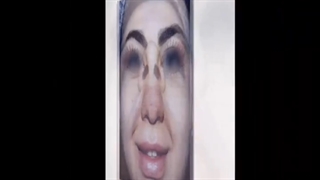 نمونه ای دیگر از جراحی ببنی…