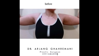 عمل جراحی براکیوپلاستی جهت از بین بردن چربی و پوست اضافه بازوها