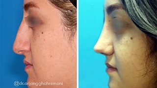 جراحی بینی نیمه فانتزی