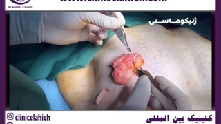 ژنیکو ماستی