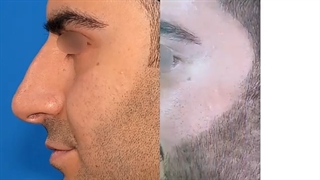 رینوپلاستی طبیعی در مردان _______________________