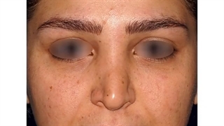 رینوپلاستی ثانویه