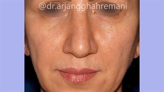 رینوپلاستی_طبیعی