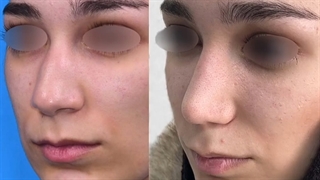 رینوپلاستی طبیعی در خانمها