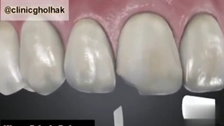 ترمیم دندان های جلو