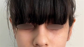 جراحی گوش برجسته (اتوپلاستی)