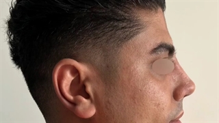 رینوپلاستی در بیمار با انحراف شدید سپتوم و پوست ضخیم