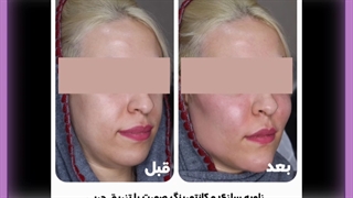 تزریق ژل و چربی به گونه
