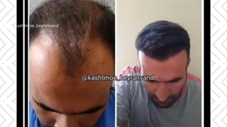 کاشت مو با جدیدترین روش