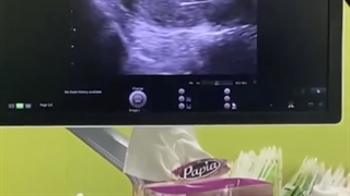 رحم سه خطی یعنی چی؟