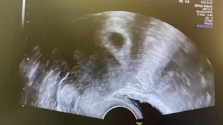 جنین ۹ هفته رو در مانیتور دیدین؟