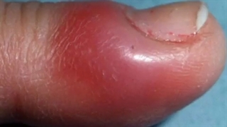 یکی از عوارض شیمی درمانی