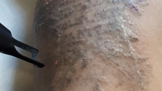 ریموو و پاک کردن تتو