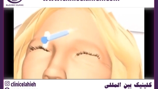 تزریق ژل به گونه با کانولا