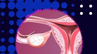 تنبلی تخمدان