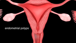 پولیپ رحم