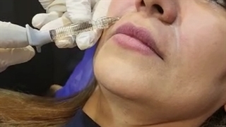 تزریق فیلر در کلینیک آرتان