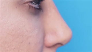 جراحی بینی طبیعی دخترونه