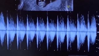 صدای ضربان قلب دوقلوها بعد از سالها انتظار