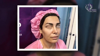 جراحی لیفت اندوسکوپی ابرو و پیشانی